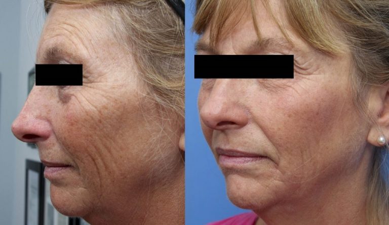 Before and After | Chemical Peels
