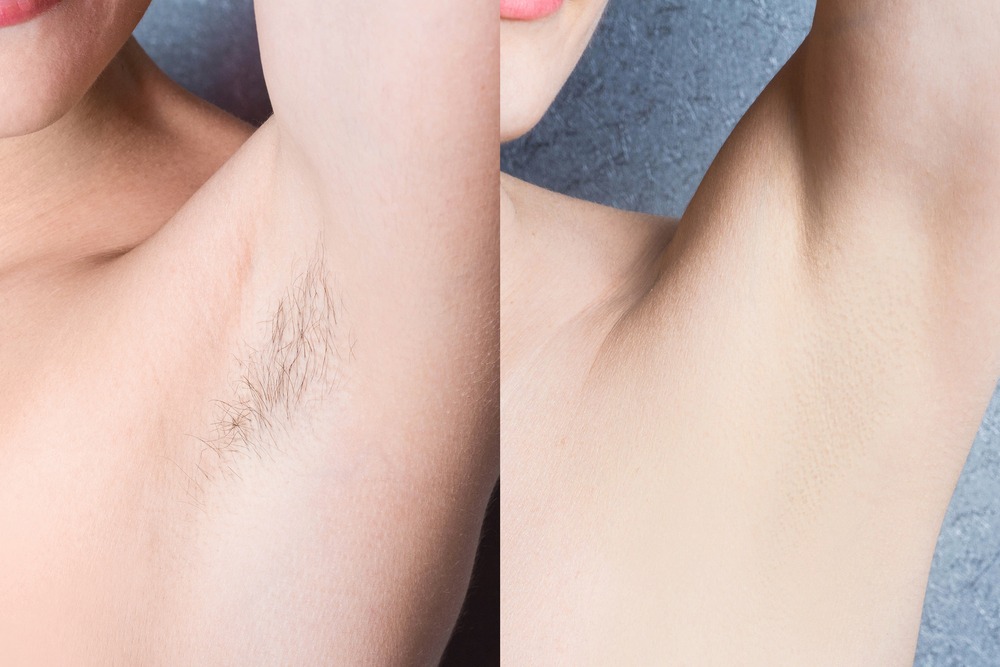 Before and After | Laser Hair Removal