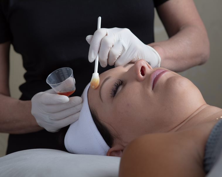 Chemical Peel on the Face to Reduce Spots and Improve Appearance of the  Skin - Clarus Dermatology Medical Surgical Cosmetic Body Sculpting