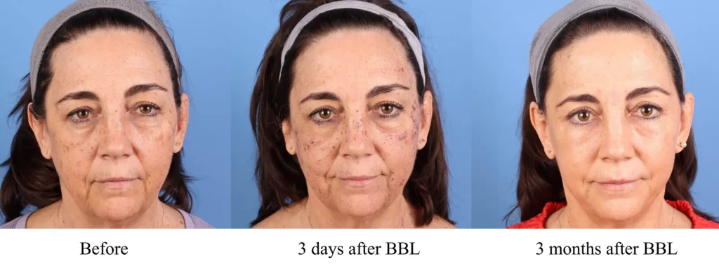 Before and After Broad Band Light | La Bella Medispa