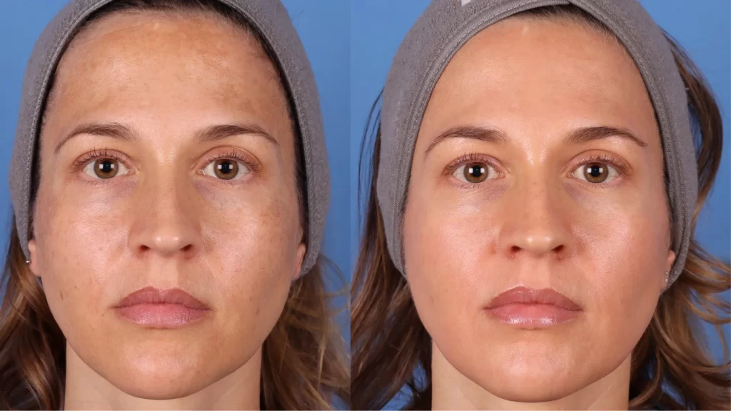 Chemical Peel | Before & After | La Bella Medispa