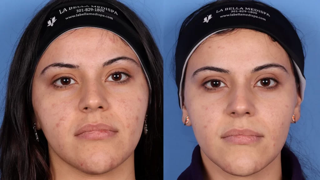 Chemical Peel | Before & After | La Bella Medispa