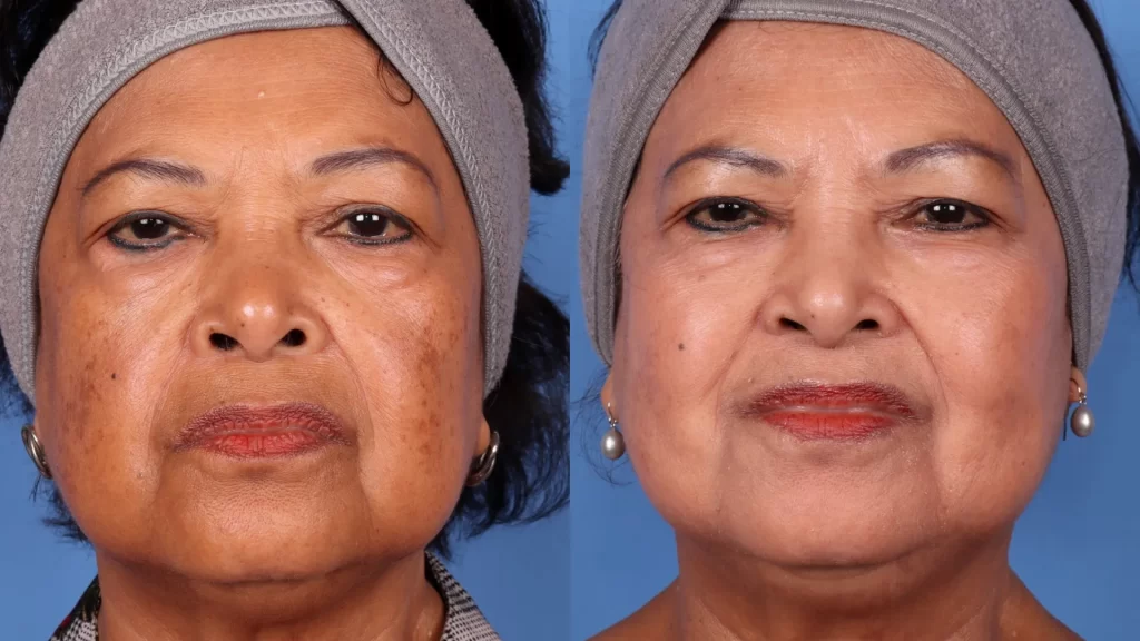 Chemical Peel | Before & After | La Bella Medispa