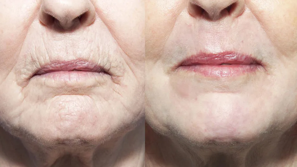 Contour TRL Before and After | La Bella Medispa