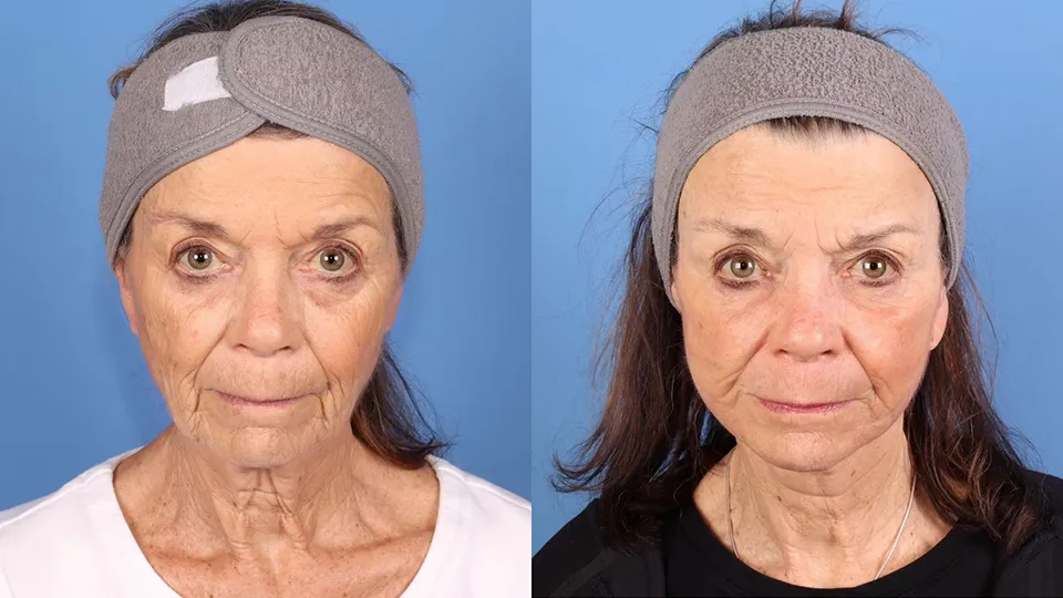 Contour TRL Before and After | La Bella Medispa