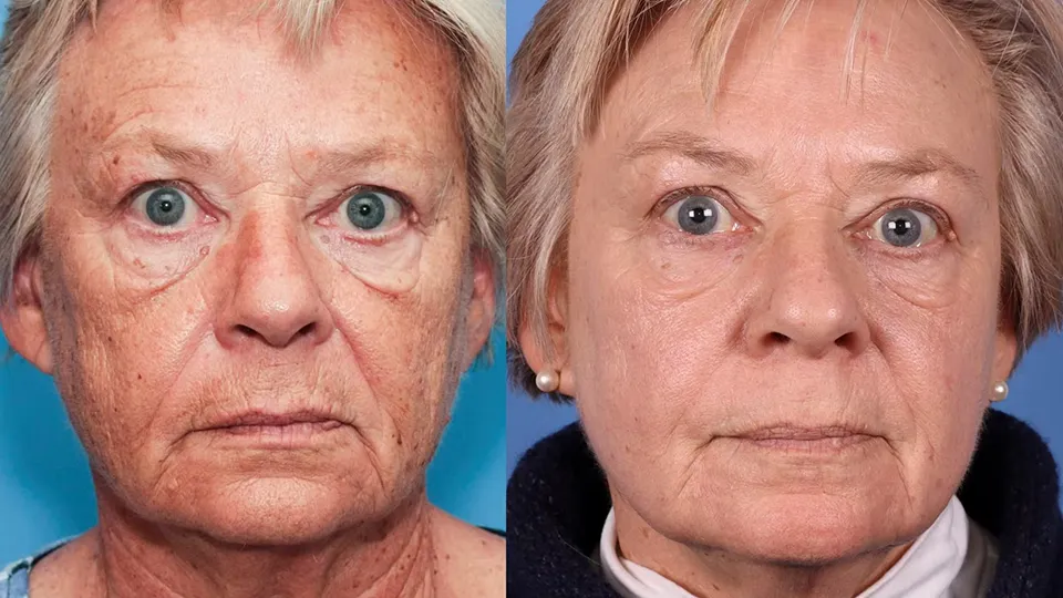 Contour TRL Before and After | La Bella Medispa