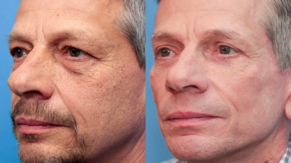 Contour TRL Before and After | La Bella Medispa