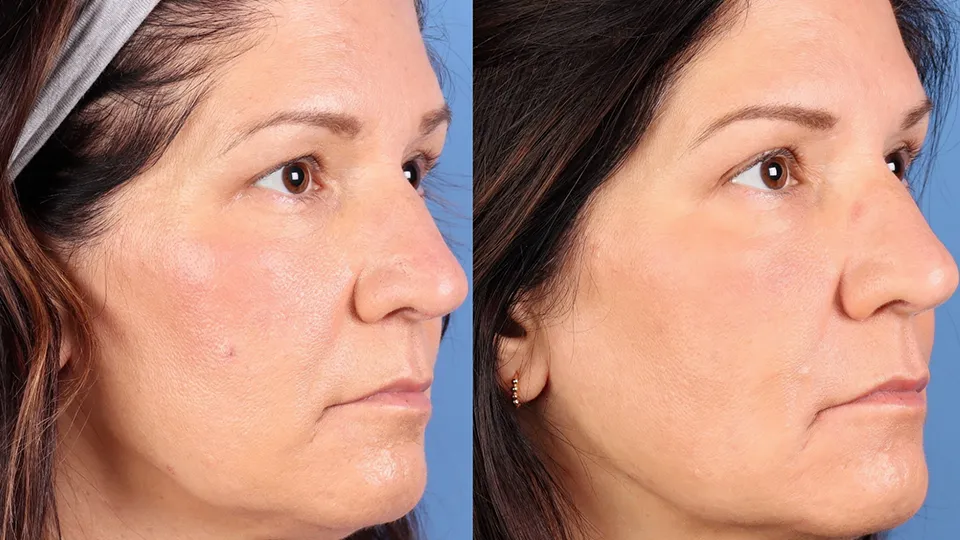 HALO Before and After | La Bella Medispa