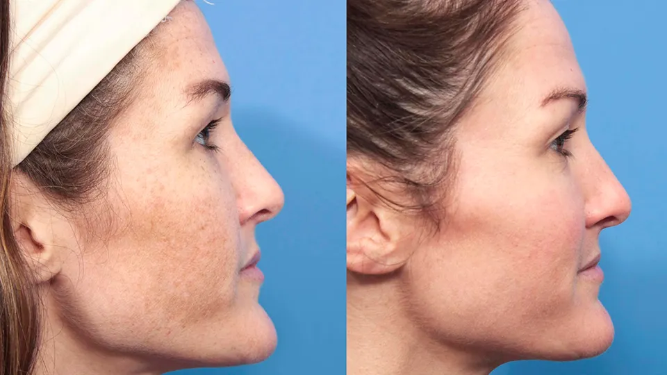 HALO Before and After | La Bella Medispa