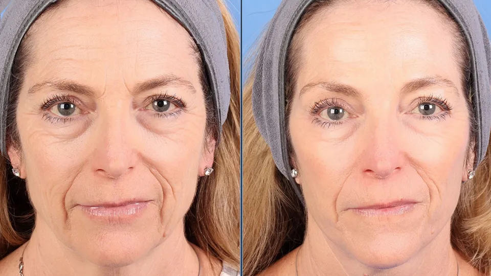 HALO Before and After | La Bella Medispa