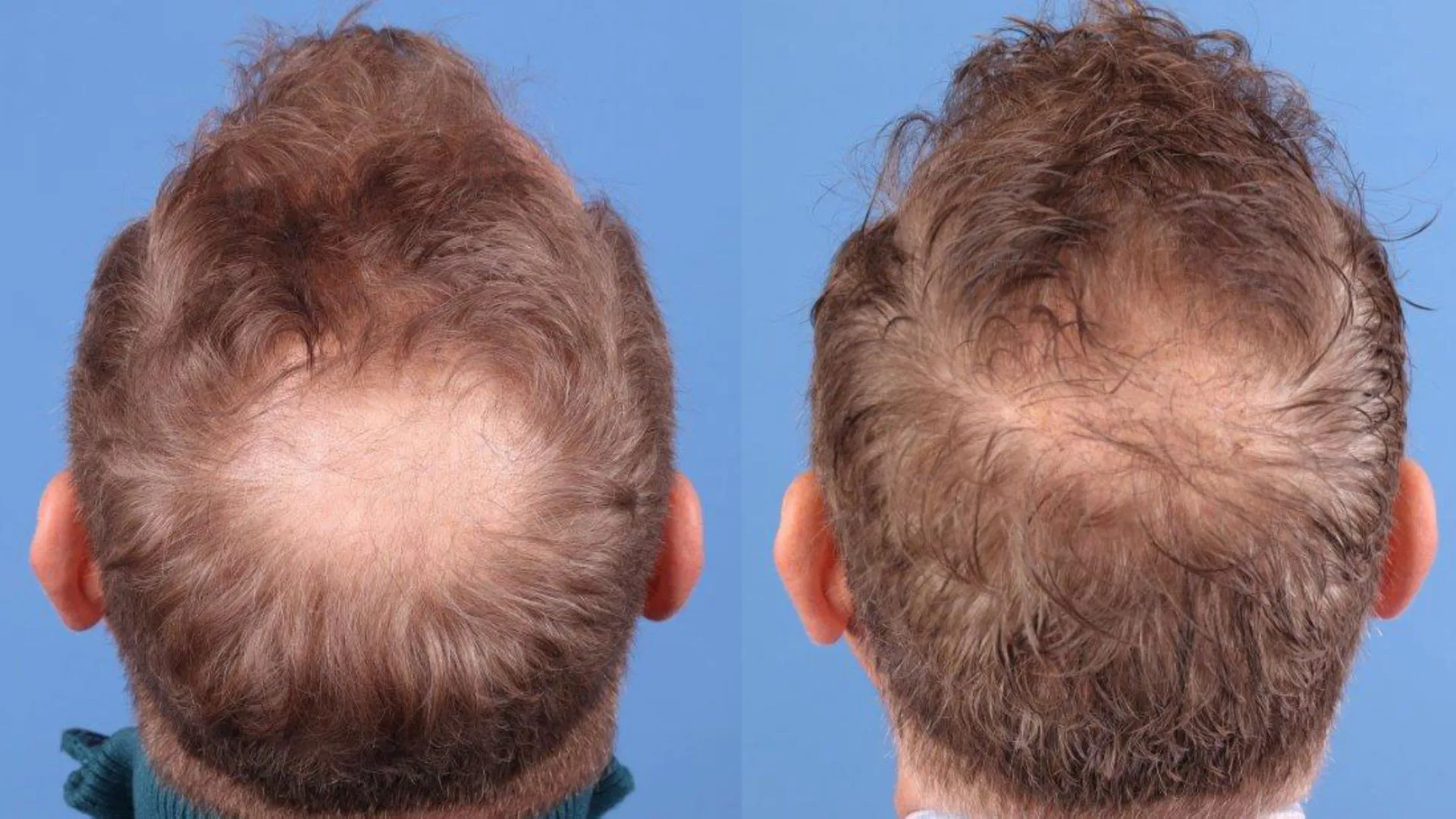 Hair Restoration Before & After | La Bella Medispa