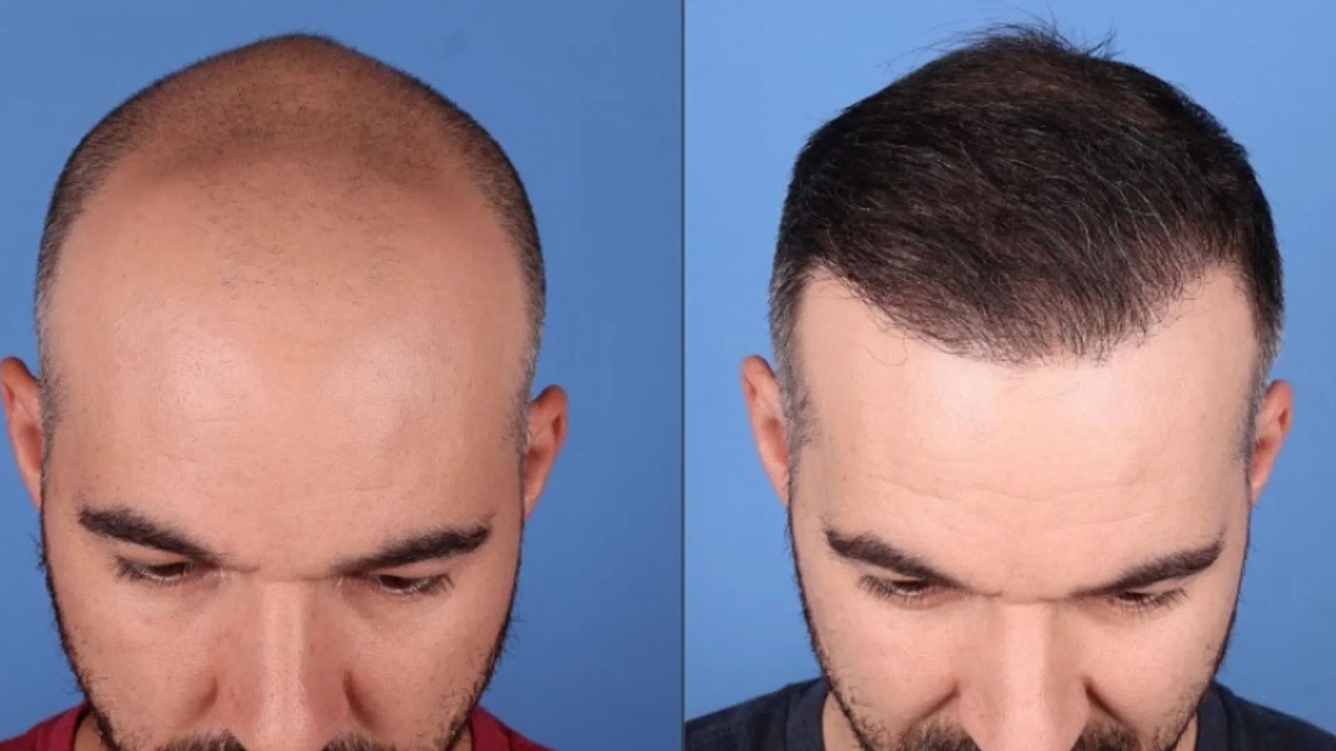Hair Restoration Before & After | La Bella Medispa
