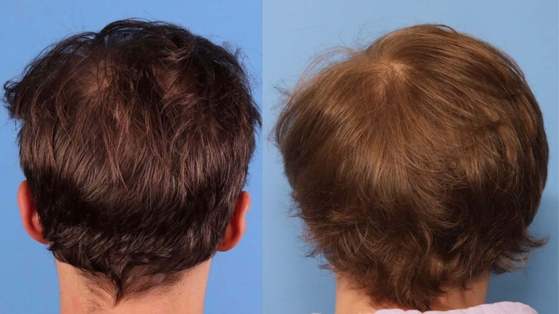 Hair Restoration Before & After | La Bella Medispa