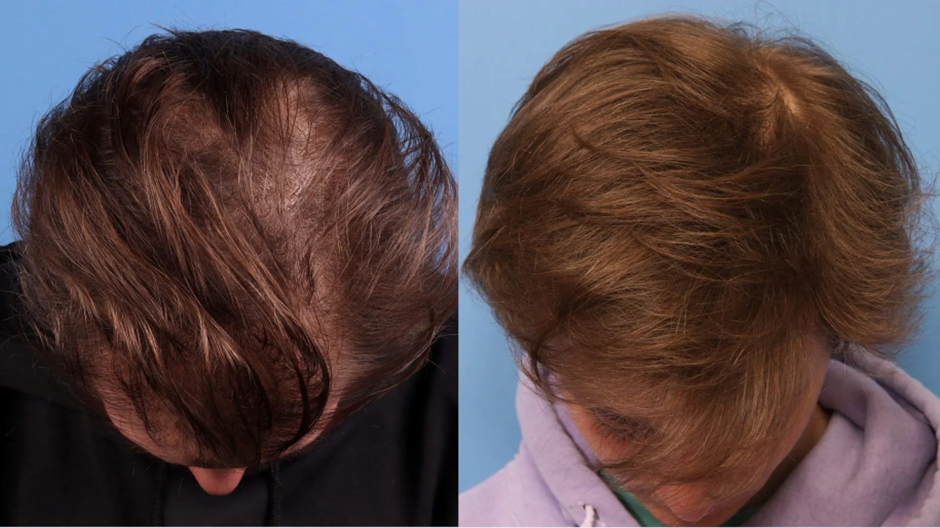 Hair Restoration Before & After | La Bella Medispa