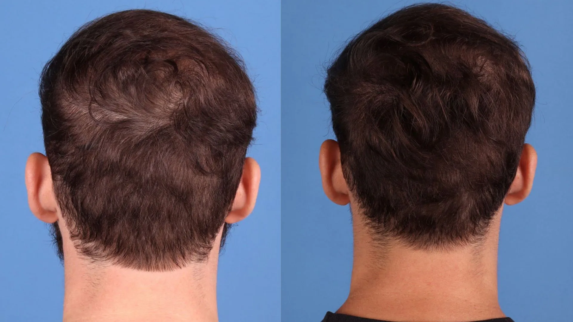 Hair Restoration Before & After | La Bella Medispa