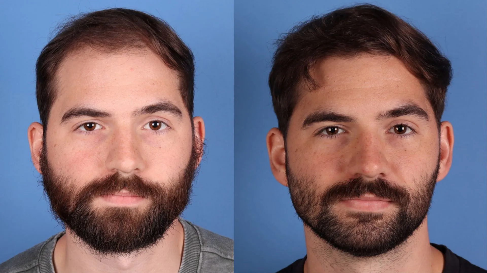 Hair Restoration Before & After | La Bella Medispa