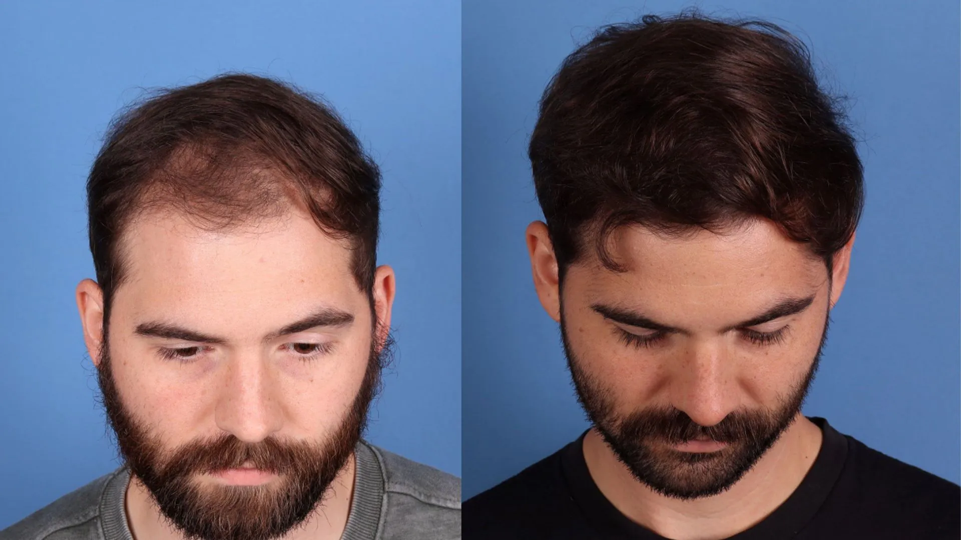 Hair Restoration Before & After | La Bella Medispa