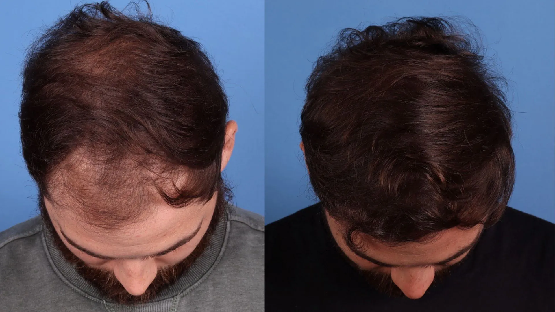Hair Restoration Before & After | La Bella Medispa