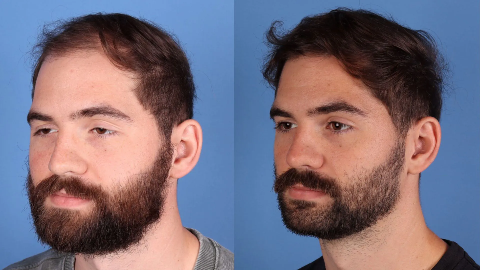 Hair Restoration Before & After | La Bella Medispa