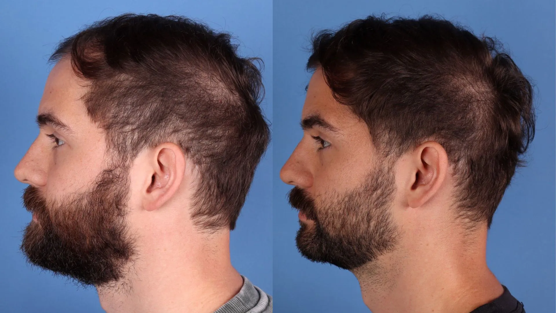 Hair Restoration Before & After | La Bella Medispa