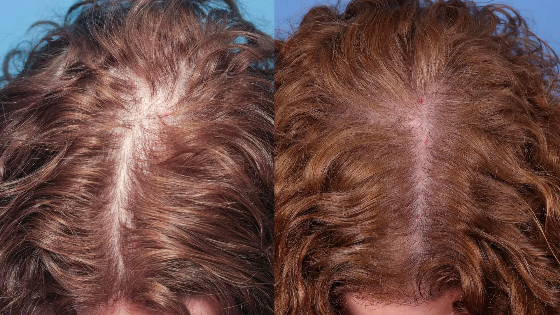 Hair Restoration Before & After | La Bella Medispa