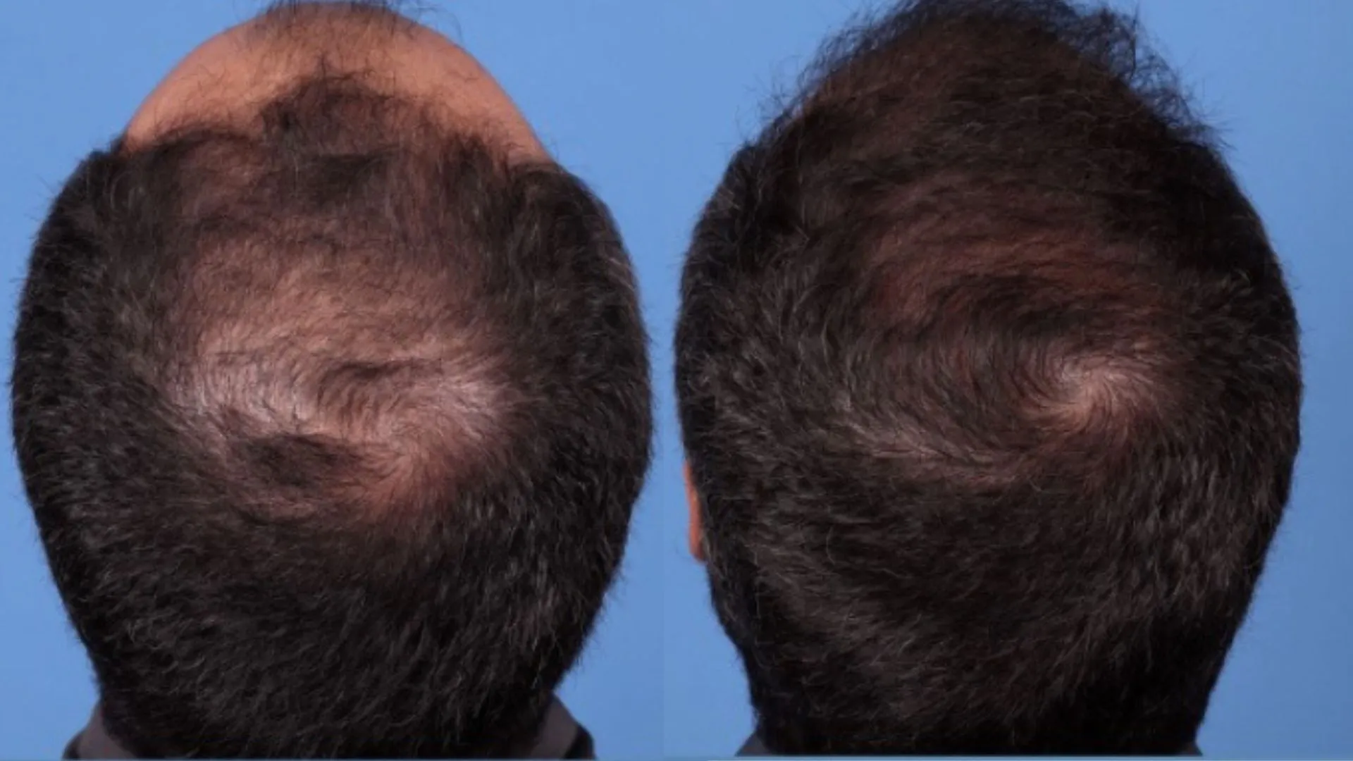 Hair Restoration Before & After | La Bella Medispa