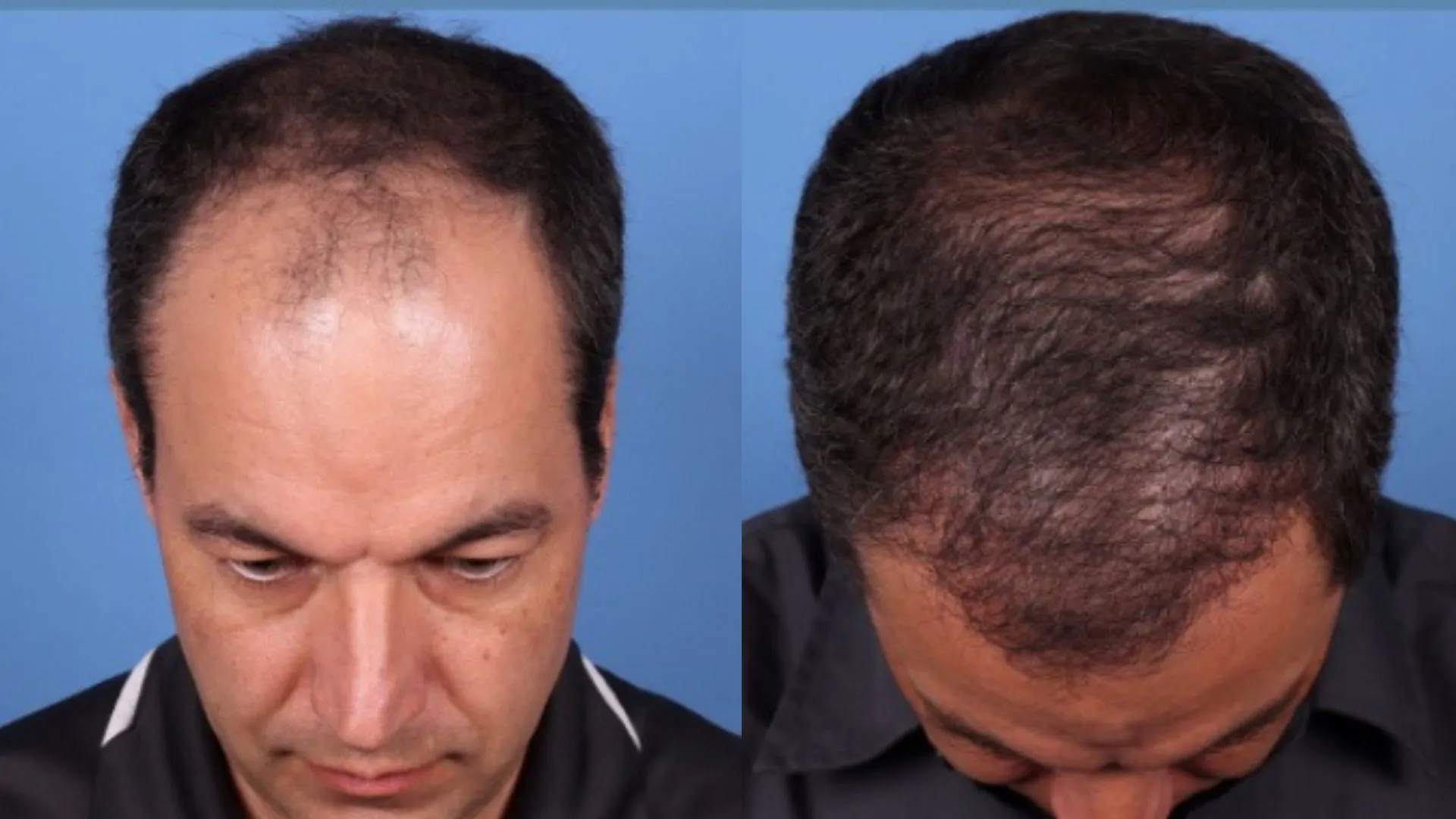 Hair Restoration Before & After | La Bella Medispa
