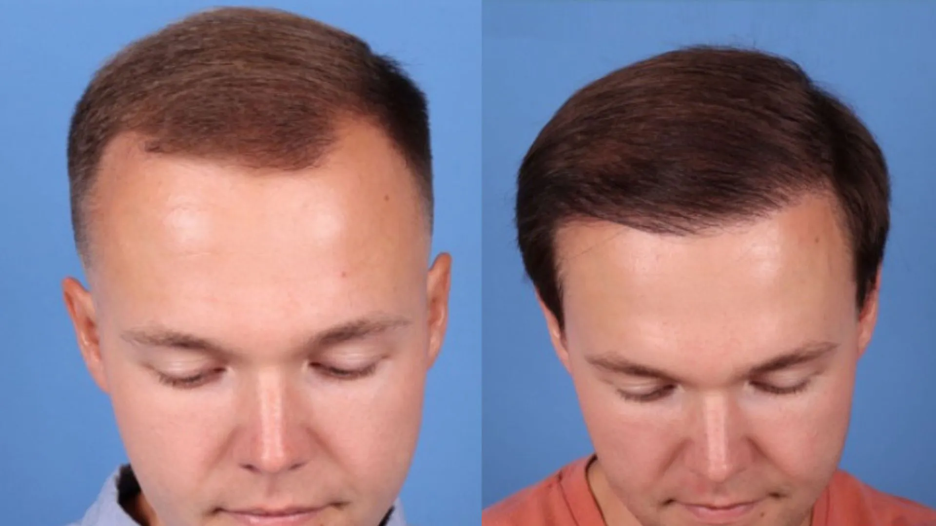Hair Restoration Before & After | La Bella Medispa