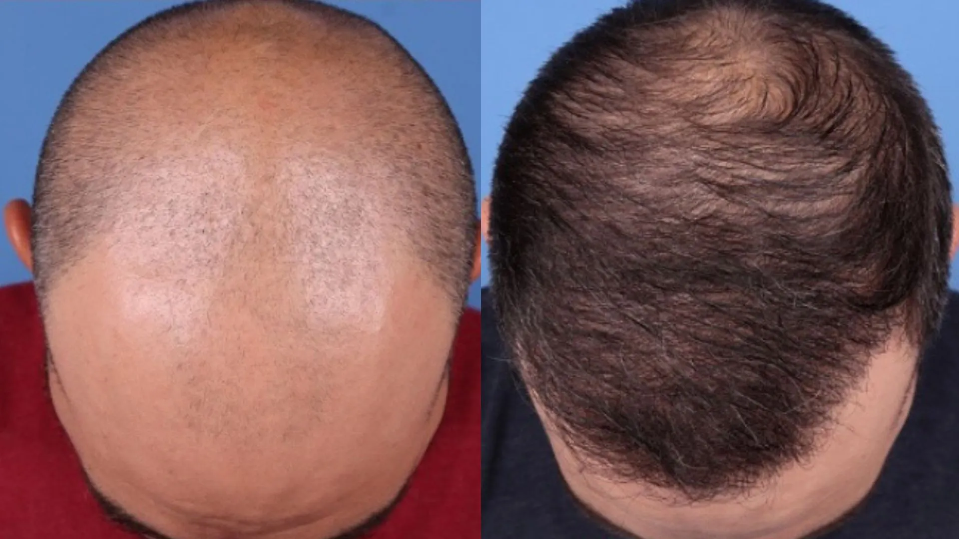 Hair Restoration Before & After | La Bella Medispa